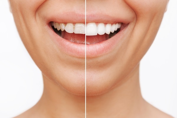 How Dental Bonding Can Minimize Gaps Between Teeth