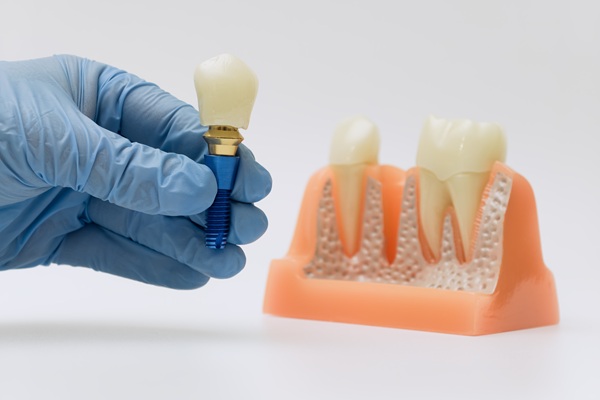 A Dental Implant And Crown For A Single Missing Tooth