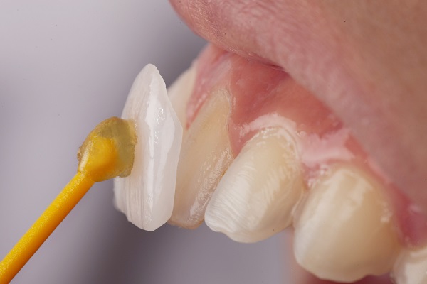 What To Expect During The Dental Veneers Process