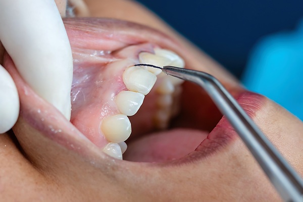 How A Family Dentist Provides Gum Disease Treatment